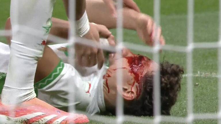 غادر النجم المغربي نيل العيناوي مغطى بالدماء بعد اصطدام رأسه مع نجم وست هام في نهائي كأس الأمم الأفريقية.